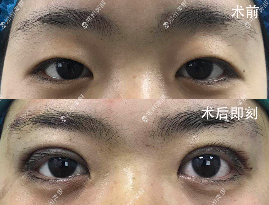 最新雙眼皮手術(shù)技巧，創(chuàng)新割雙眼皮方法解析